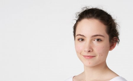 combination skin acne