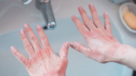 Eczema on hands