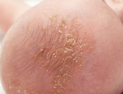 cradle cap shampoo ireland